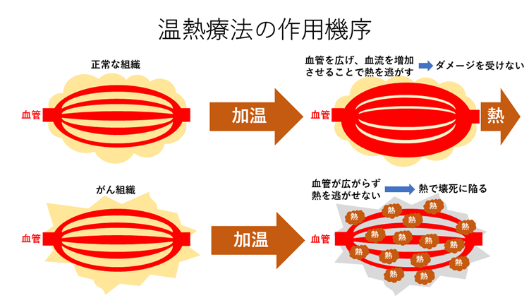 温熱療法